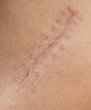 Traitement cicatrices