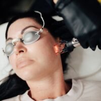 Picoway traitement hyperpigmentation