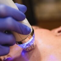 Pinxel microneedling RF